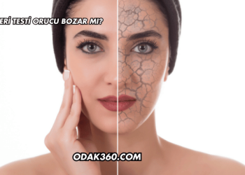 Deri Testi Orucu Bozar mı?
